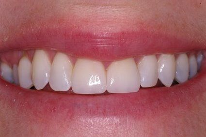 Flawlessly restored smile after treatment