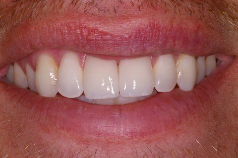 Perfectly repaired top front tooth