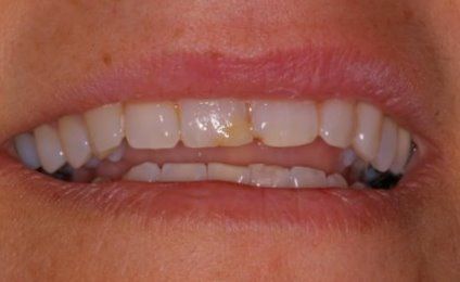 Worn and damaged teeth