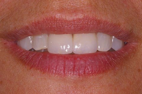 Two top teeth brightened