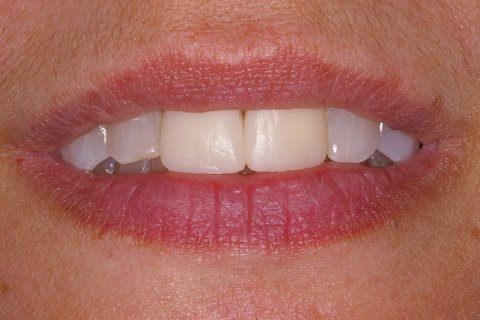Two top teeth discolored