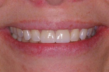 Bright white front top teeth