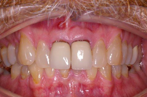 Discolored and decayed teeth