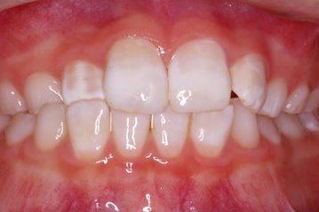 Healthy and white front teeth
