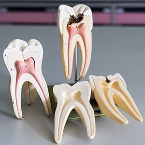 Models of damaged and healthy teeth before and after root canal therapy