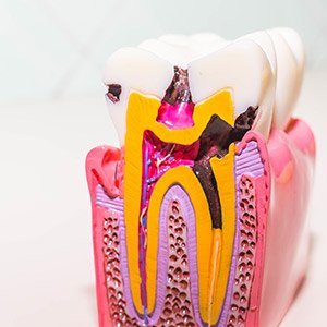 Model of a the inside of a damaged tooth in need of root canal therapy