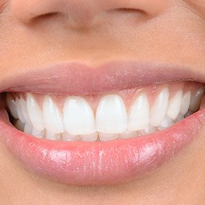 Closeup of bright white smile after teeth whitening