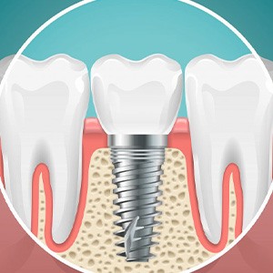 Graphic of a dental implant that shows the gums and jawbone