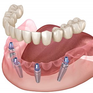 Exploded illustration of All-on-4 dentures