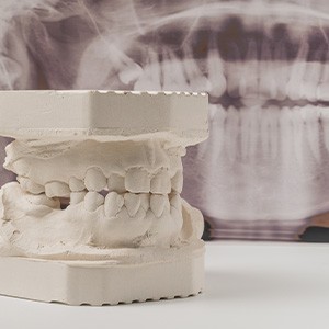 An example of a denture mold
