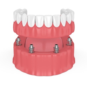 Animated smile with All-on-4 dental implants