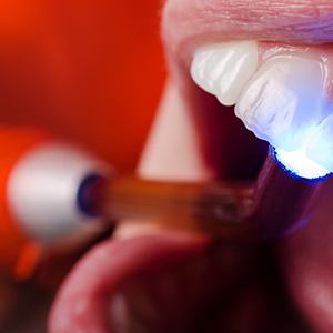 Dental light hardening composite resin