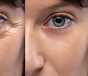 Before and after Botox patient in Haverhill