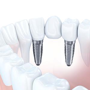 Implant-supported dental bridge