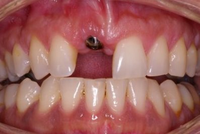 Missing top tooth with implant visible
