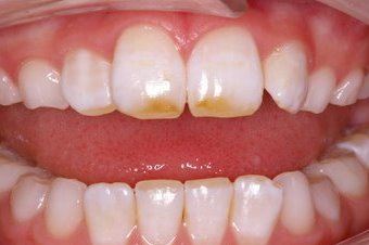 Dark staining on teeth