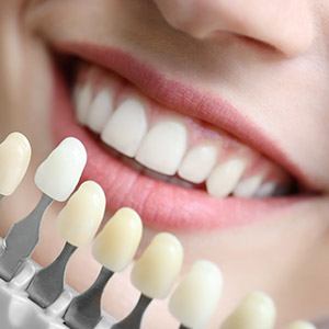 Teeth compared with dental bonding color chart