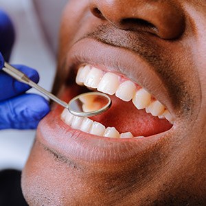 Patient receiving dental exam after tooth colored fillings
