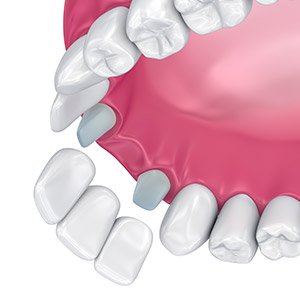 Animation of dental bridge placement