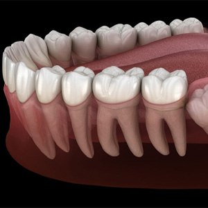 illustration of wisdom tooth pushing against other teeth 