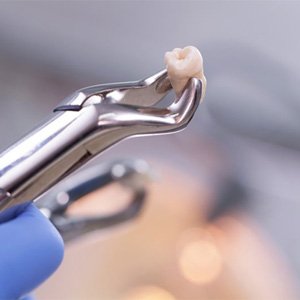 dentist holding extracted wisdom tooth in forceps   