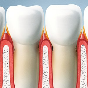 Animation of damaged gum tissue