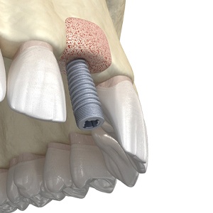 Digital illustration of bone graft for dental implants in Haverhill.