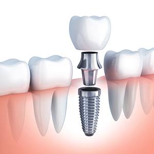 Animated dental implant and dental crown replacing a single missing tooth 