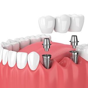 two dental implants with a dental bridge