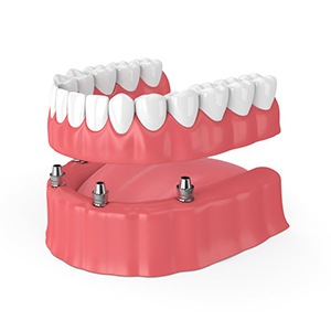four dental implants with a denture