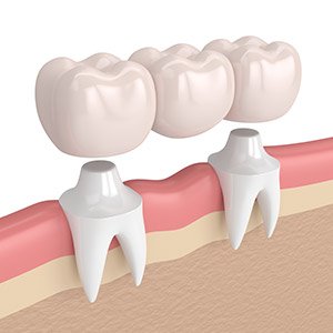 Animation of dental bridge placement