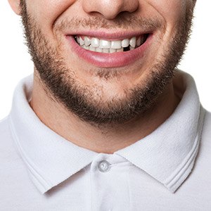 Closeup of smile with missing tooth before restorative dentistry