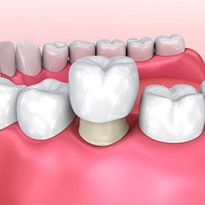 Animation of metal free dental restoration placement