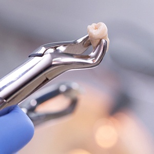 Close-up of extracted tooth being held in dental forceps