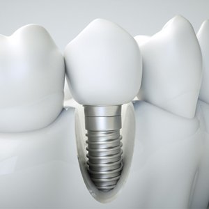 dental implant model