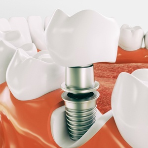 dental implant close-up