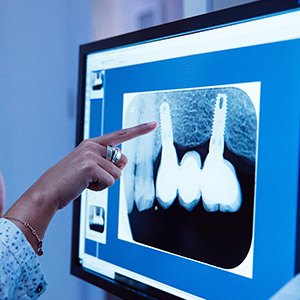 X-ray of dental implant supported crown