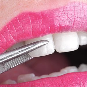 Closeup of smile during porcelain veneer placement