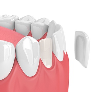 Animated smile during porcelain veneer treatment