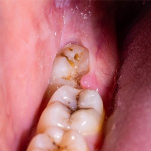 Close-up of an impacted wisdom tooth